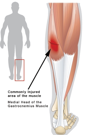 Recovery time for torn calf muscle - Medical Experts